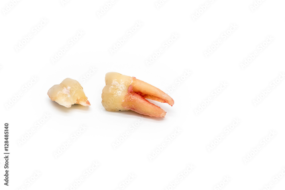 broken tooth removal with dental caries on white