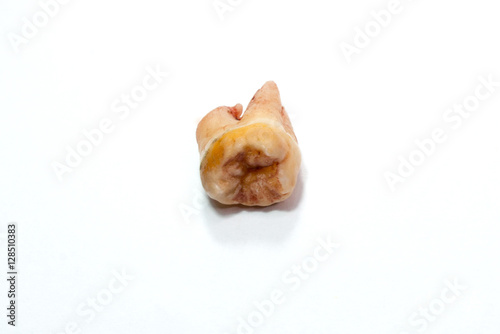 Tooth removal