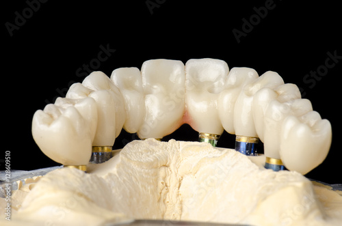 Monolithic zirconia restorations full arch implant