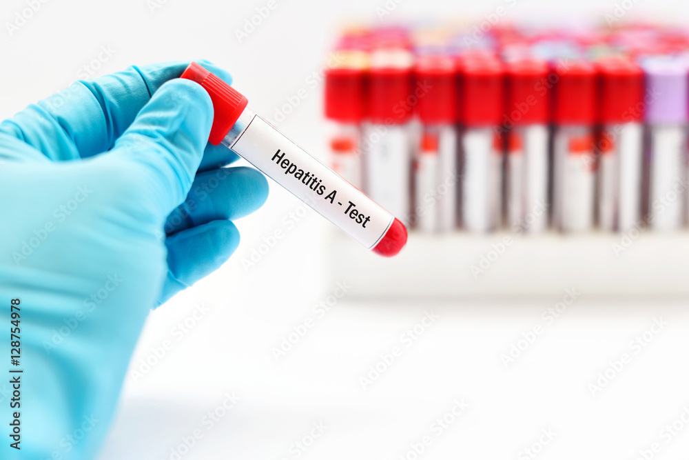 Obraz premium Hepatitis A virus (HAV) test