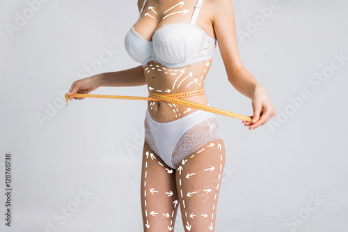Woman in underwear with liposuction outlines. Plastic Surgery treatment of cellulite