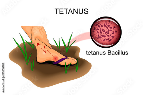 damage to the feet. the risk of tetanus photo