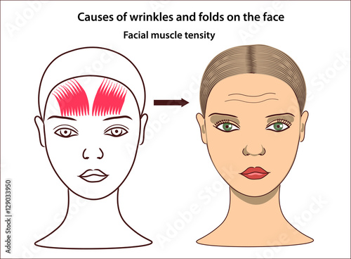 Женское лицо с мимическими морщинами и складками. Схематическое изображение напряженных лицевых мышц