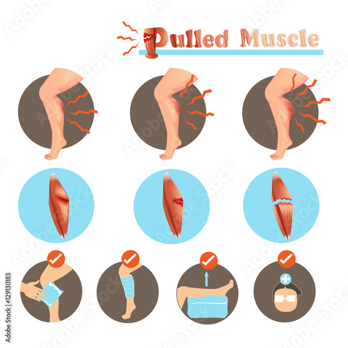 Muscle Strain Treatment Pulled Muscle degree and  Treatment isolated on white background.Vector illustrations