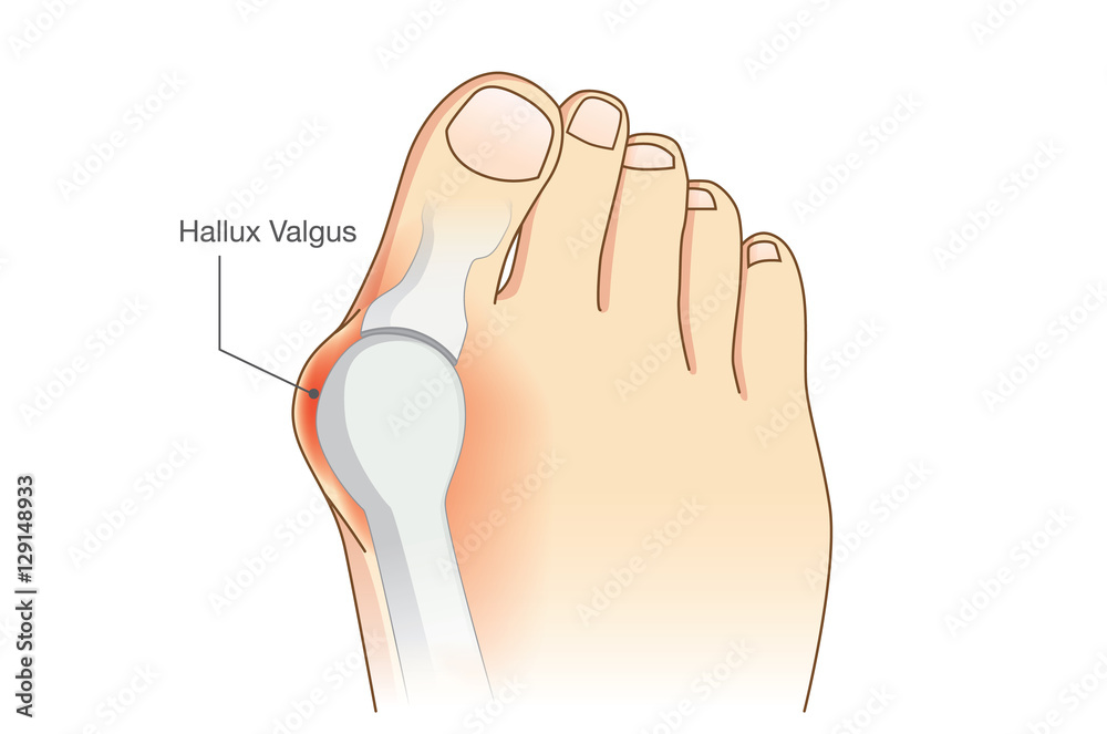 Abnormal of foot shape from deformity joint connecting the big toe