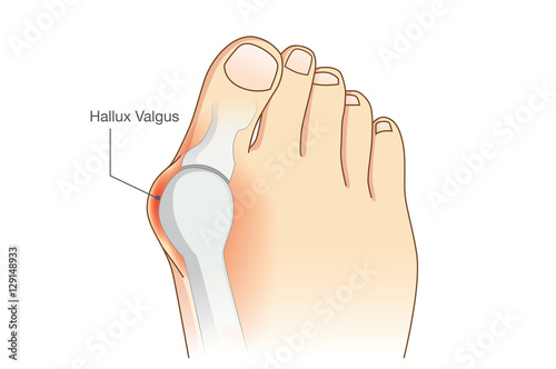Abnormal of foot shape from deformity joint connecting the big toe. Problem of foot form wearing high heel make.