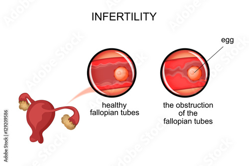 uterus.infertility due to obstruction of the fallopian tubes photo