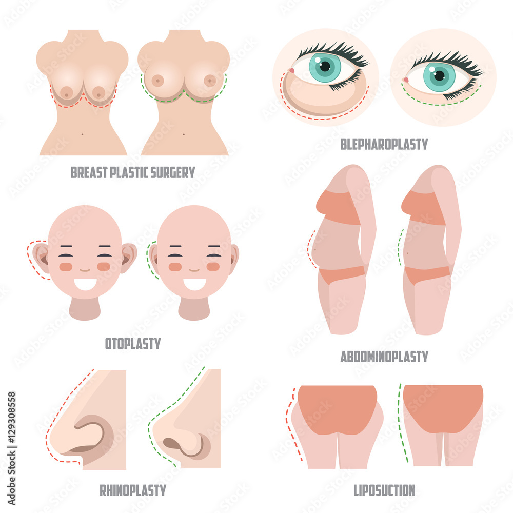 Types of outlet plastic surgery