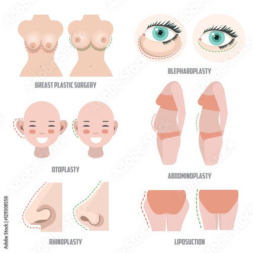 Plastic surgery set. Before ans after surgery example. vector illustrations of otoplasty; blepharoplasty; rhinoplasty; liposuction; abdominoplasty and breast surgery.