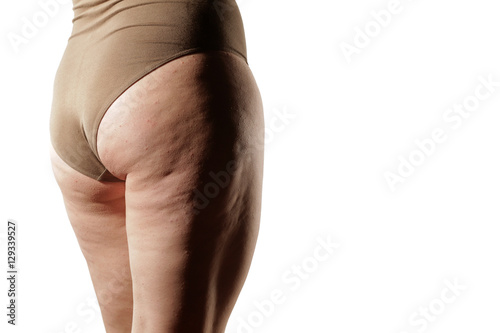 legs and buttocks of obese women and cellulite
