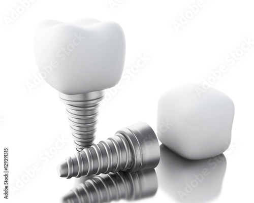 3D Dental tooth implant.