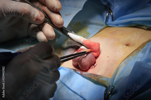 Surgeon squeezes the stoma by surgical forceps during the colostomy surgery
