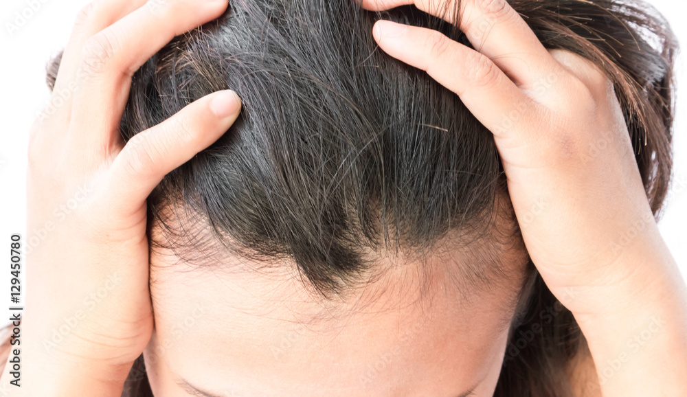 Woman serious hair loss problem for health care shampoo and beau Woman serious hair loss problem for health care shampoo and beau