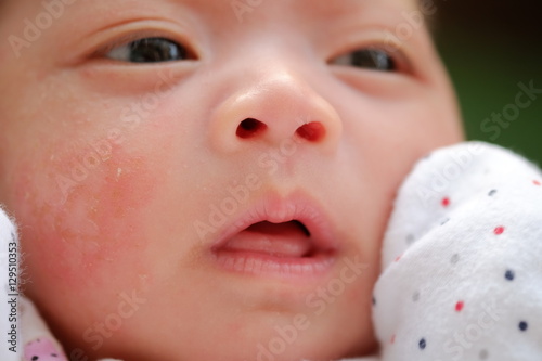 Portrait of a newborn baby close-up. face baby rashes