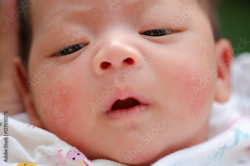 Portrait of a newborn baby close-up. face baby rashes