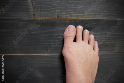 Foto Hallux valgus, bunion in foot