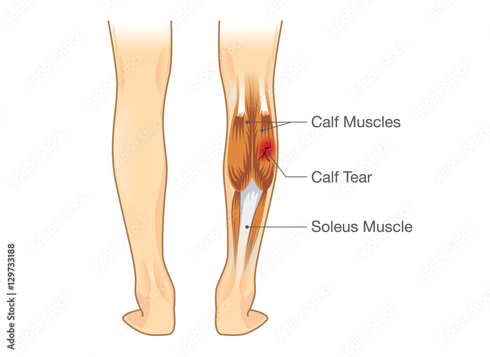 calf-muscle-tear-illustration-about-leg-injury-from-inflammatory