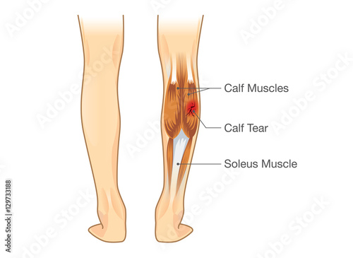 Calf muscle tear. Illustration about leg Injury from inflammatory.
