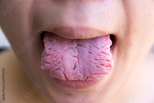 Bacterial infection disease tongue,The tongue is thrush.Tongue w