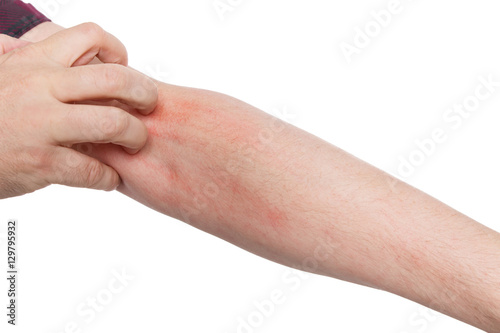 Tableau sur toile Mann kratzt sich am Arm, Krätze oder Dermatillomanie