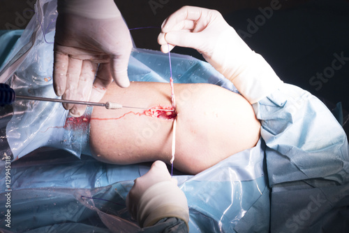Surgical operation knee surgery