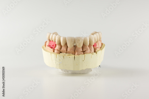 the denture made of ceramics located on plaster model