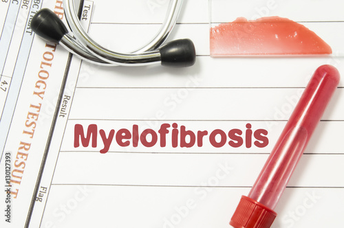 Diagnosis of Myelofibrosis. Laboratory blood bottle (tube), glass slide with blood smear, hematology test, stethoscope lying on notebook with printed text hematological diagnosis of Myelofibrosis