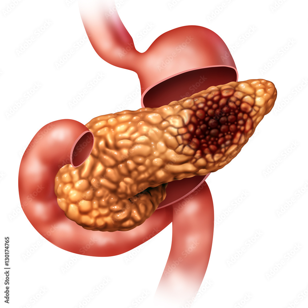 Pancreatic Cancer Concept Stock Illustration | Adobe Stock