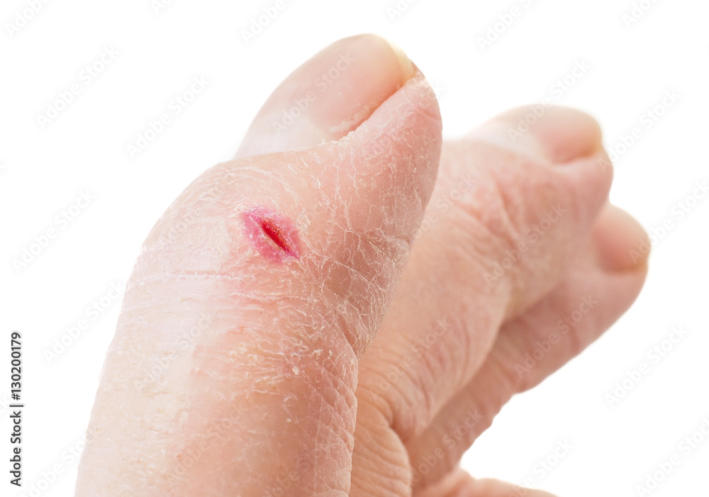 Closeup of finger with infected cut, isolated on white backgroun Closeup of finger with infected cut, isolated on white backgroun