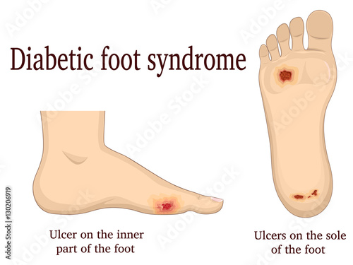 Illustration of diabetic foot syndrome. Shown ulcers on the inside and plantar of the foot.