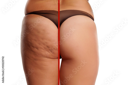 comparing female ass with and without cellulite photo