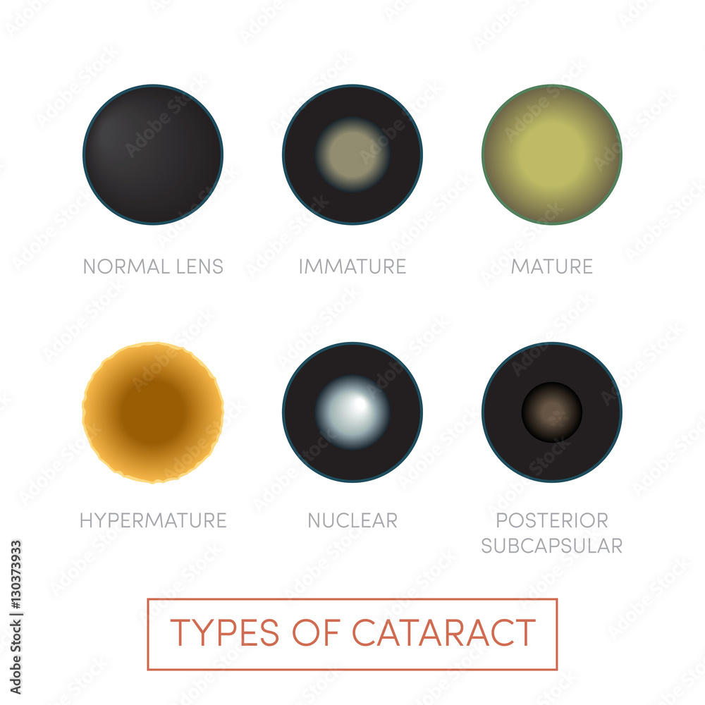 Types of cataract Stock Illustration | Adobe Stock