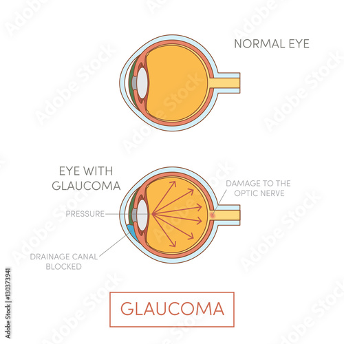 Glaucoma eye, vector