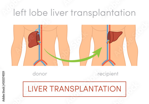 Liver transplantation concept