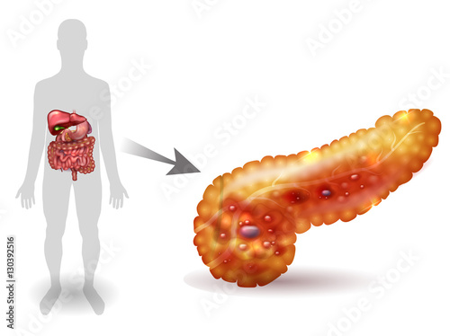 Pancreatitis illustration, inflammation of pancreas on a white background. Human silhouette and internal organs.