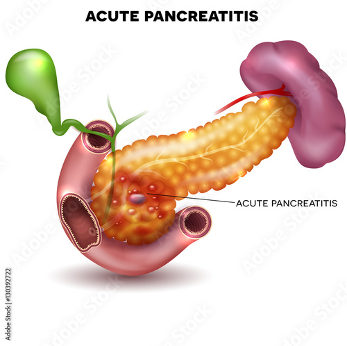 Pancreatitis illustration, inflammation of pancreas and other surrounding organs on a white background photo