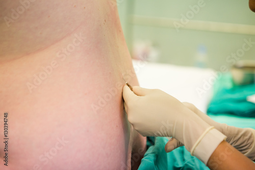 Close up image of a doctor doing a spinal block epidural on a pregnat woman just before child birth is to take place. photo