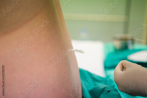 Close up image of a doctor doing a spinal block epidural on a pregnat woman just before child birth is to take place. photo