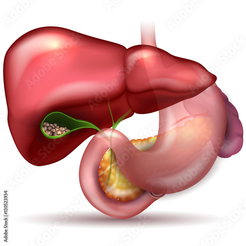 Gallstones in the Gallbladder and anatomy of surrounding organs.