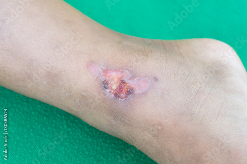 Leg ulcers