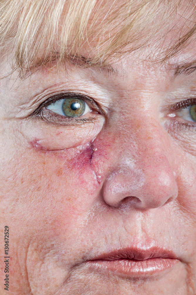 Mature woman with scar and spitting suture one week after Mohs surgery