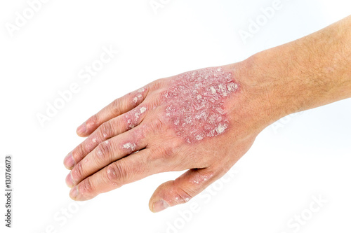 Foto psoriasis on the hand isolated on white