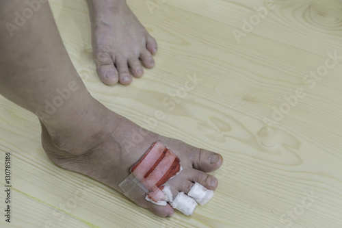 scar on foot of Asian women by dog bite injury on wooden background ..