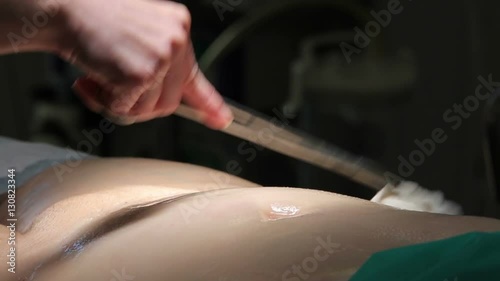 Bare female belly sterilization with wet gauze holden in the clamp close-up before the surgery (1080p, 25fps)