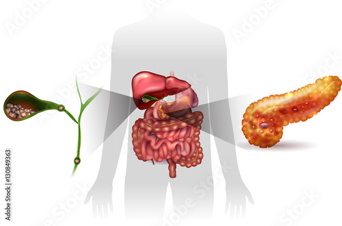 Gallstones in the Gallbladder and acute pancreatitis, anatomy bright detailed illustration.