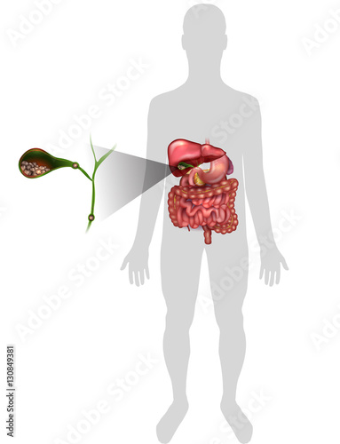 Gallstones in the Gallbladder, anatomy bright detailed illustration