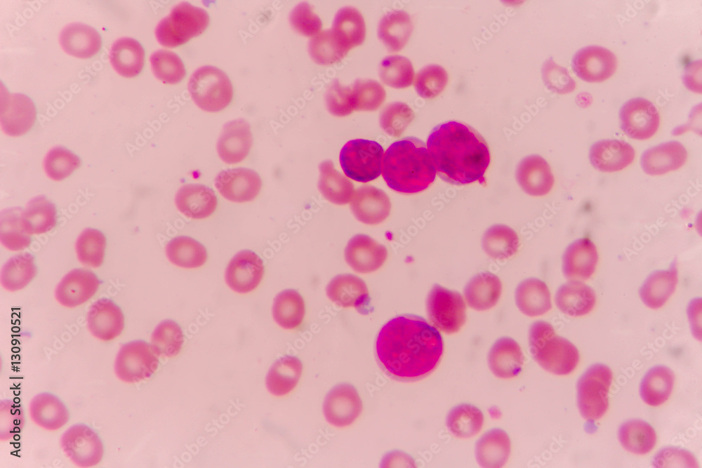 Blast cells in Leukemia