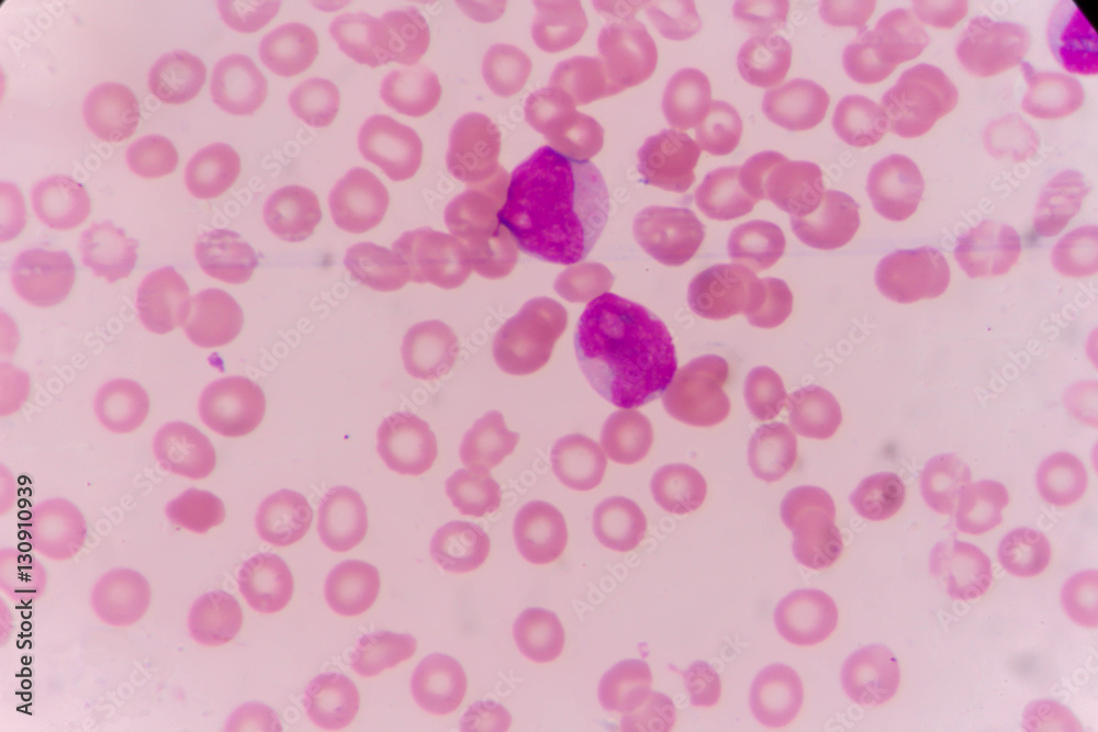 Blast cells in Leukemia