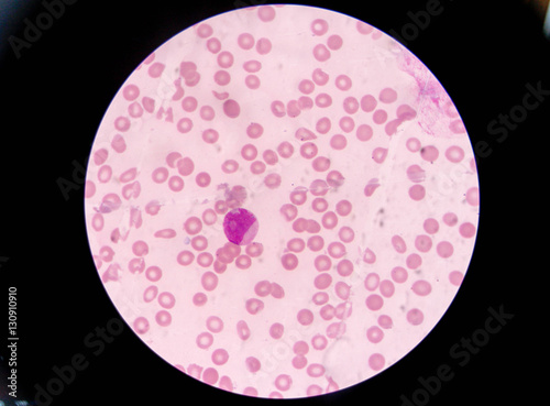 Blast cells in Leukemia