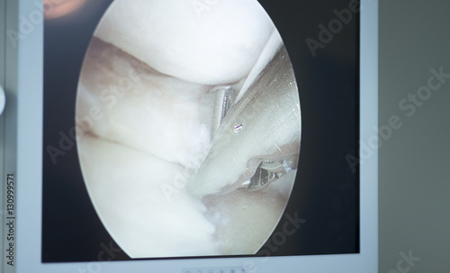 Konstfotografi Arthroscopy surgery screen